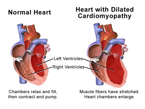 Dilaterende cardiomyopathie (DCM) .